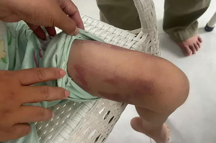 Bé gái Phạm Thị MT (9 tuổi) bị mẹ ruột và người tình thường xuyên đánh đập gây nhiều thương tích.