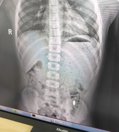 Kết quả phim chụp cho thấy hạt đậu vàng trong dạ dày cậu bé 11 tuổi. Ảnh: Baidu