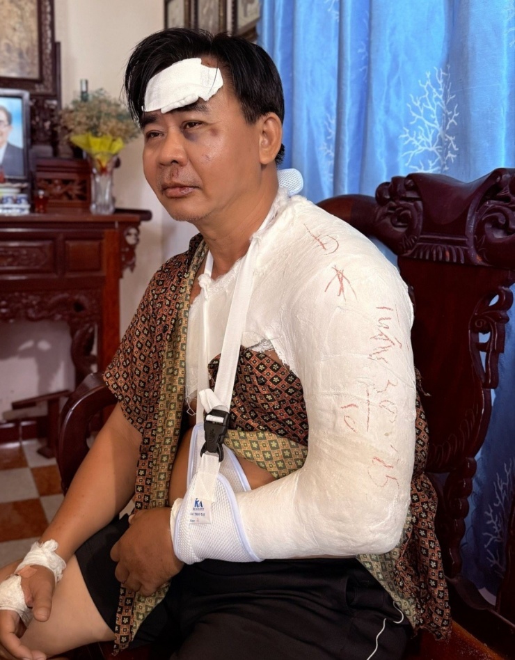 Nam nghệ sĩ phải bó bột khoảng một tháng.