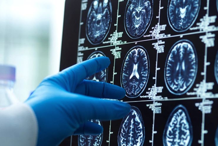 Các nhà khoa học sửng sốt vì phát hiện não người đầy vi nhựa