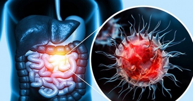 Có dấu hiệu này khi đi đại tiện, coi chừng ung thư đại tràng "ghé thăm"