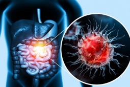 Sức khỏe đời sống - Có dấu hiệu này khi đi đại tiện, coi chừng ung thư đại tràng "ghé thăm"