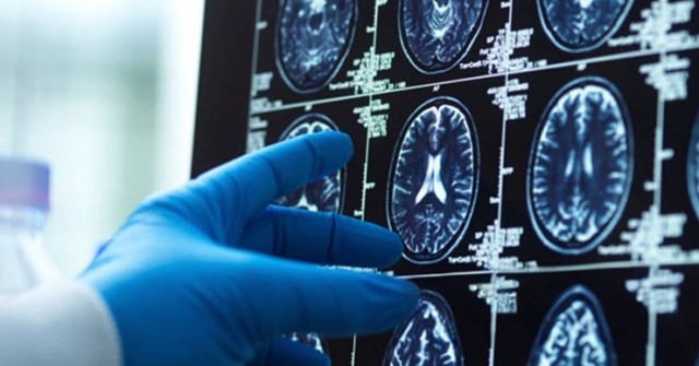 Các nhà khoa học sửng sốt vì phát hiện não người đầy vi nhựa