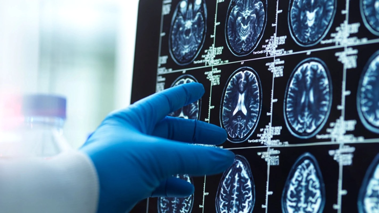 Phát hiện khối u bí ẩn trong não người, hóa ra là vi nhựa.