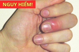 Tin tức sức khỏe - 3 dấu hiệu trên ngón tay cảnh báo phổi đang bị “tàn phá”, đi khám ngay kẻo “ân hận cả đời”!