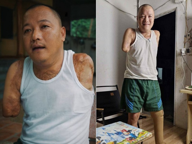 Anh Đạt mất 2 tay và 1 chân sau tai nạn kinh hoàng 