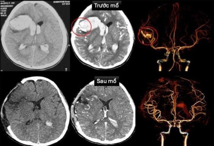 Vùng xuất huyết do vỡ dị dạng mạch máu não ở bệnh nhi trước và sau phẫu thuật