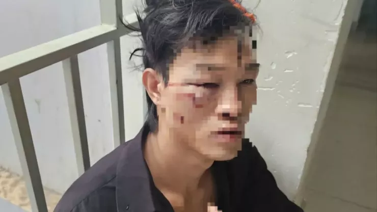 Anh Kha bị nhiều vết thương ở đầu và mặt. Ảnh: N.V