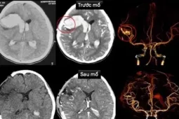 Sức khỏe đời sống - Hy hữu bé gái 13 tuổi bị đột quỵ