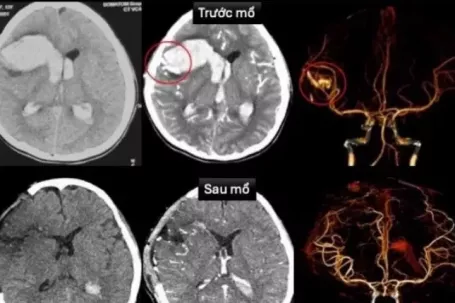 Hy hữu bé gái 13 tuổi bị đột quỵ