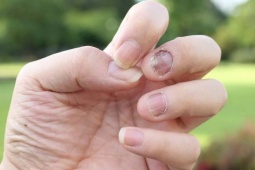 6 dấu hiệu ở móng tay cảnh báo nguy cơ mắc bệnh nguy hiểm