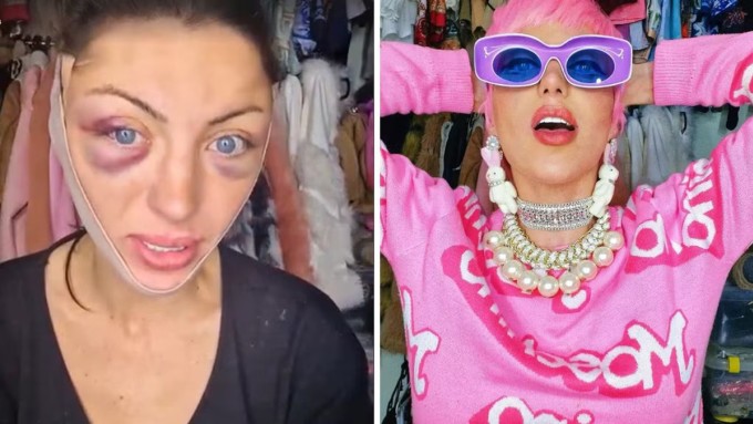 'Búp bê Barbie đời thực' bị sưng tím mắt trước khi qua đời. Ảnh: Instagram