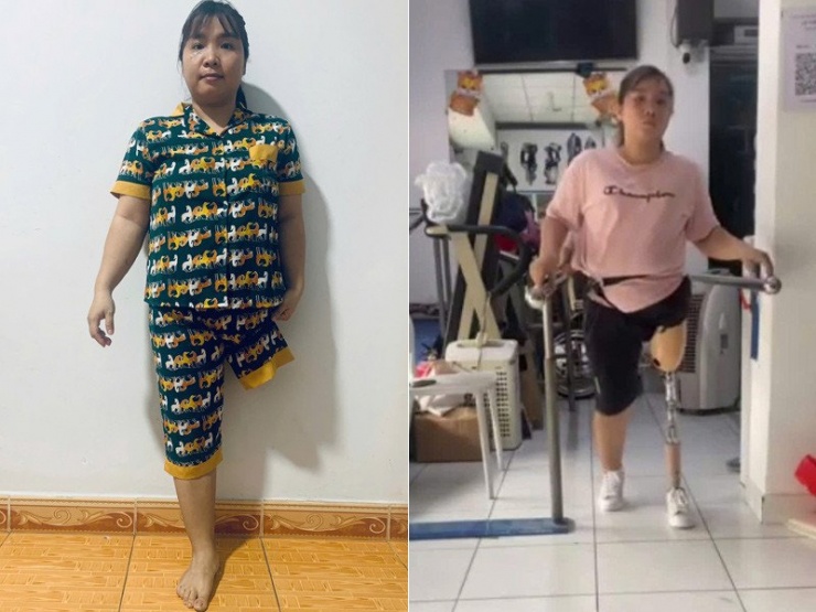 Tai nạn kinh hoàng đã cướp đi 1 chân của Nhung 