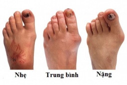 Tin tức sức khỏe - Thói quen ai cũng mắc phải khiến xương khớp “xuống cấp” không phanh