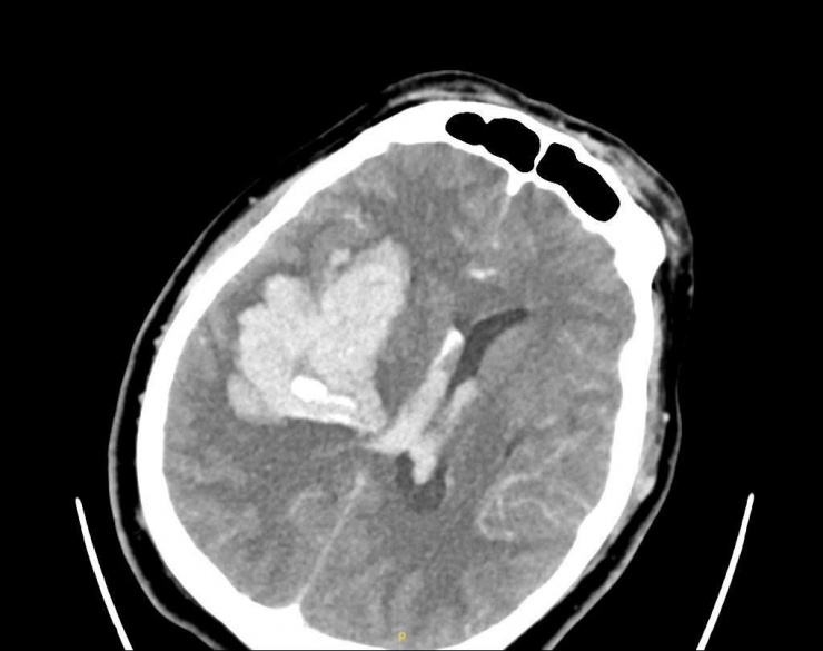 Hình ảnh phim chụp bệnh nhân bị xuất huyết não lượng lớn bán cầu phải. Ảnh: BVCC.