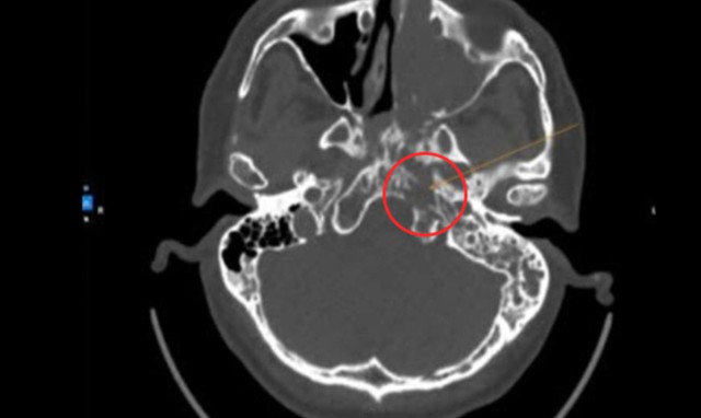 Hình ảnh CT-scan ghi nhận khối u hốc mũi che lấp vùng vòm họng người bệnh. Ảnh: BVCC
