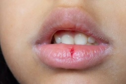 Sức khỏe đời sống - 6 dấu hiệu ở môi cảnh báo sức khỏe đang có vấn đề