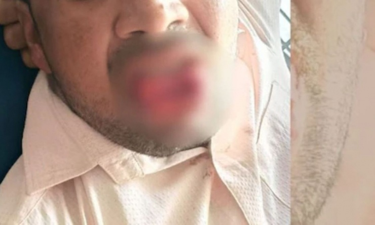 Người đàn ông bị cắn đứt lưỡi sau khi cưỡng hôn người phụ nữ.