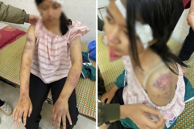 Cháu P.A. với nhiều vết bầm tím trên cơ thể.