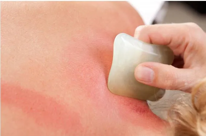 Không phải ai khi bệnh, đau nhức, mệt mỏi cũng có thể áp dụng phương pháp cạo gió. (Ảnh minh họa)