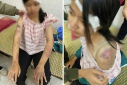 An ninh - Xã hội - Bé gái 13 tuổi bị ông bà bạo hành đến mức nhập viện cấp cứu