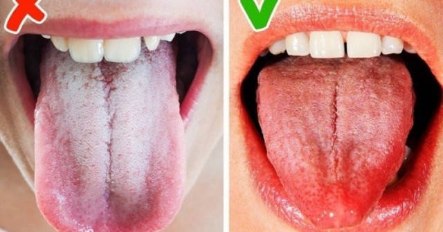 Lưỡi có 10 dấu hiệu này cần đi khám sớm kẻo gặp họa