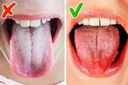 Sức khỏe đời sống - Lưỡi có 10 dấu hiệu này cần đi khám sớm kẻo gặp họa