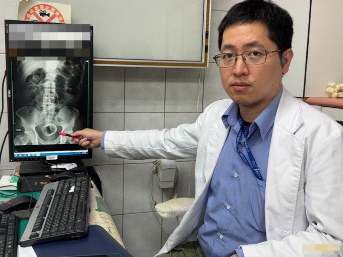 Bác sĩ Ngô Khôn Đạt đã phẫu thuật lấy chiếc cốc bị nhét vào hậu môn của một bệnh nhân ở thành phố Đài Trung. Ảnh: Zhang Xuanzhe