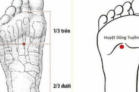 Bác sĩ y học cổ truyền khuyến cáo một số biện pháp phòng ngừa đột quỵ...