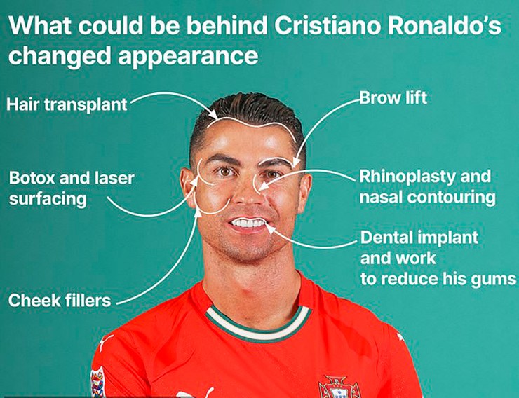 Các thủ thuật phẫu thuật thẩm mỹ được cho là của Ronaldo, theo Tiến sĩ Elie Levine