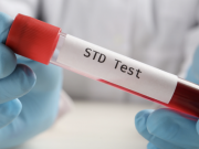 1 bệnh viện ở TP HCM ghi nhận 1 năm hơn 38.000 ca sùi mào gà