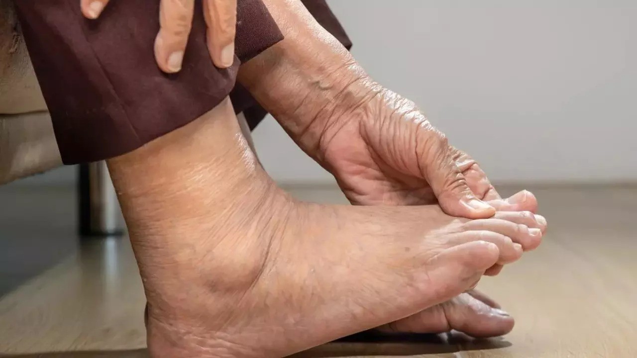 Dấu hiệu ở chân cảnh báo bệnh gan, suy tim và cục máu đông - 4