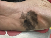 Đốm đen trên da có phải là dấu hiệu ung thư da?