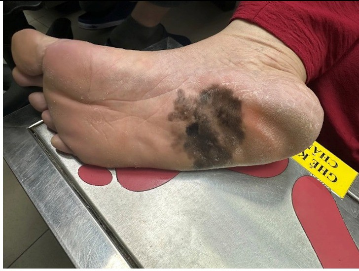 Hình ảnh tổn thương màu đen ở gan bàn chân của bệnh nhân được phát hiện ung thư da