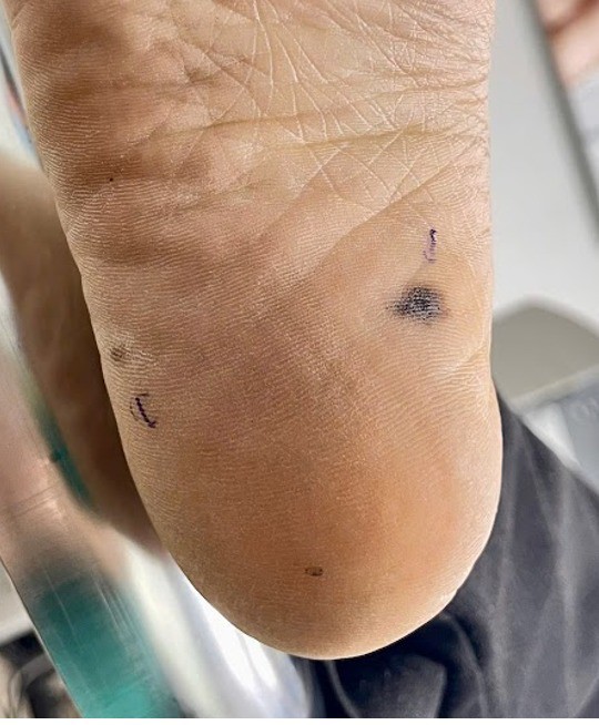 Hình ảnh tổn thương màu đen ở gan bàn chân của bệnh nhân được phát hiện ung thư da