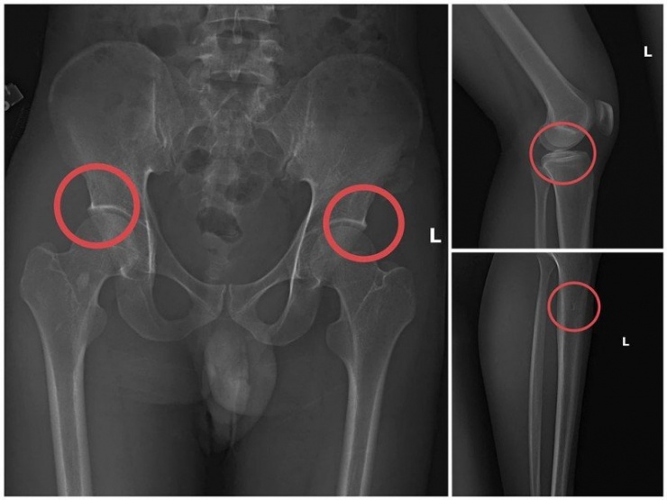 Phim chụp XQ một số tổn thương xương do đối tượng Tạ Minh Châu tạo ra.