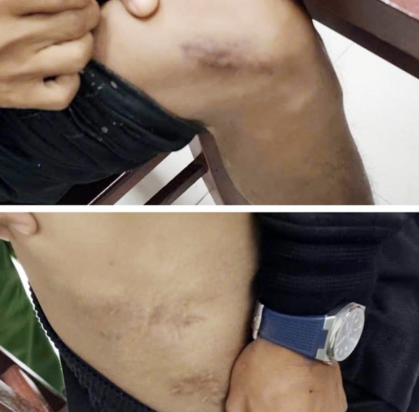 Hình ảnh vết thương trên người đứng tên mua bảo hiểm do đối tượng Tạ Minh Châu tạo ra.