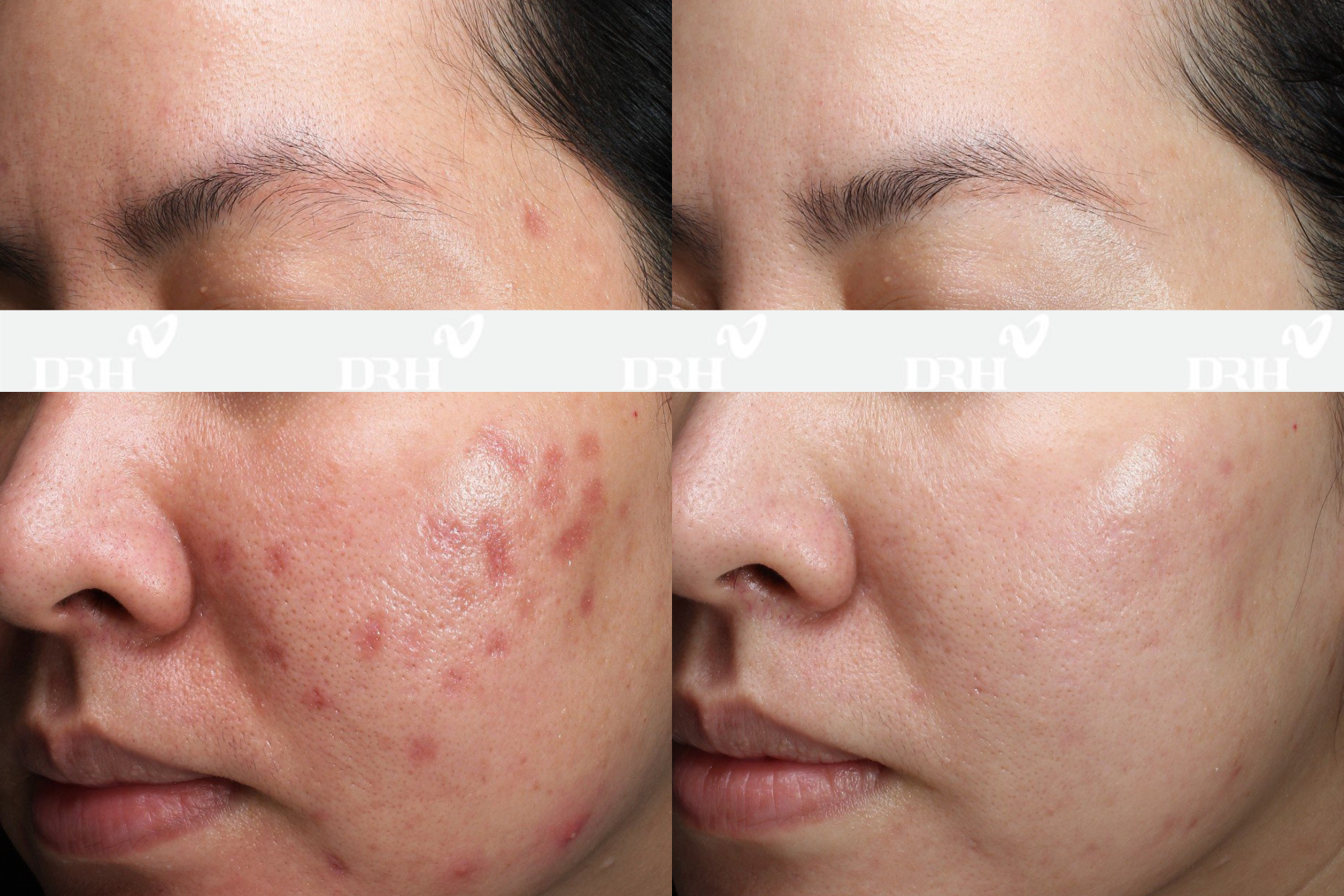 Khắc phục trường hợp biến chứng sau tiêm Mesotherapy tại phòng khám DRH Clinic