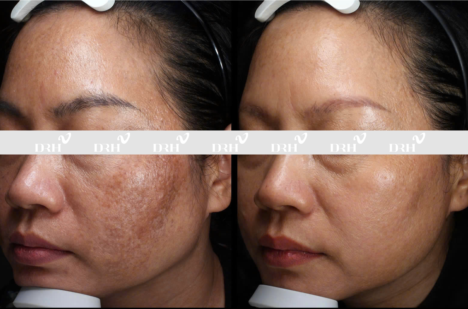 Thành công giải cứu trường hợp bị nám biến chứng do kem trộn tại DRH Clinic