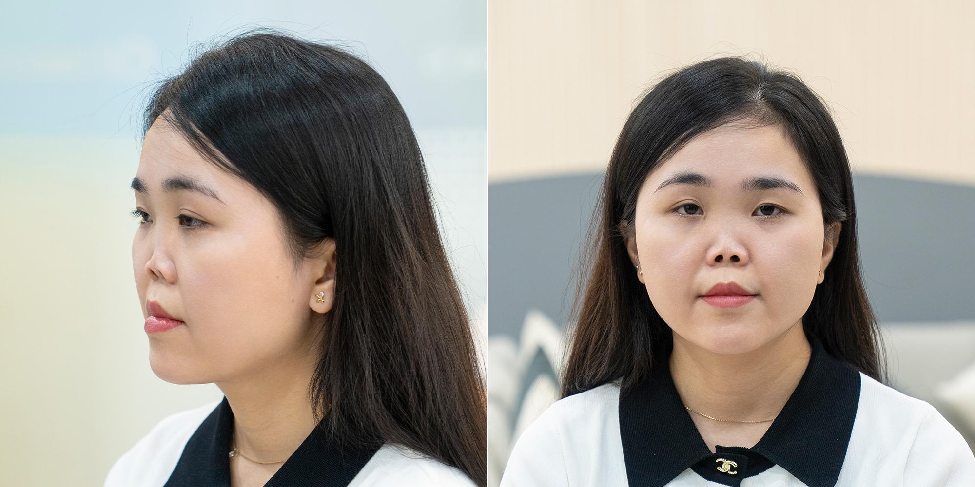 “Chỉ cần được có một chiếc mũi bình thường như mọi người, với tôi đó là ước mơ cả đời…” - Vân Anh chia sẻ.