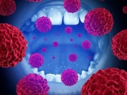 Những dấu hiệu phát hiện sớm ung thư miệng rất dễ bỏ qua