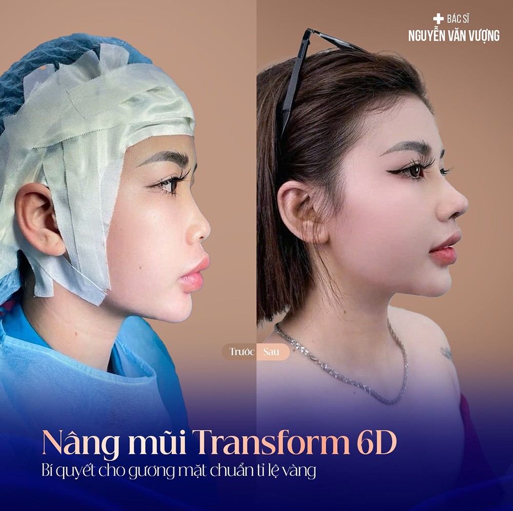 Nâng mũi Transform 6D - Bí quyết cho gương mặt chuẩn tỉ lệ vàng