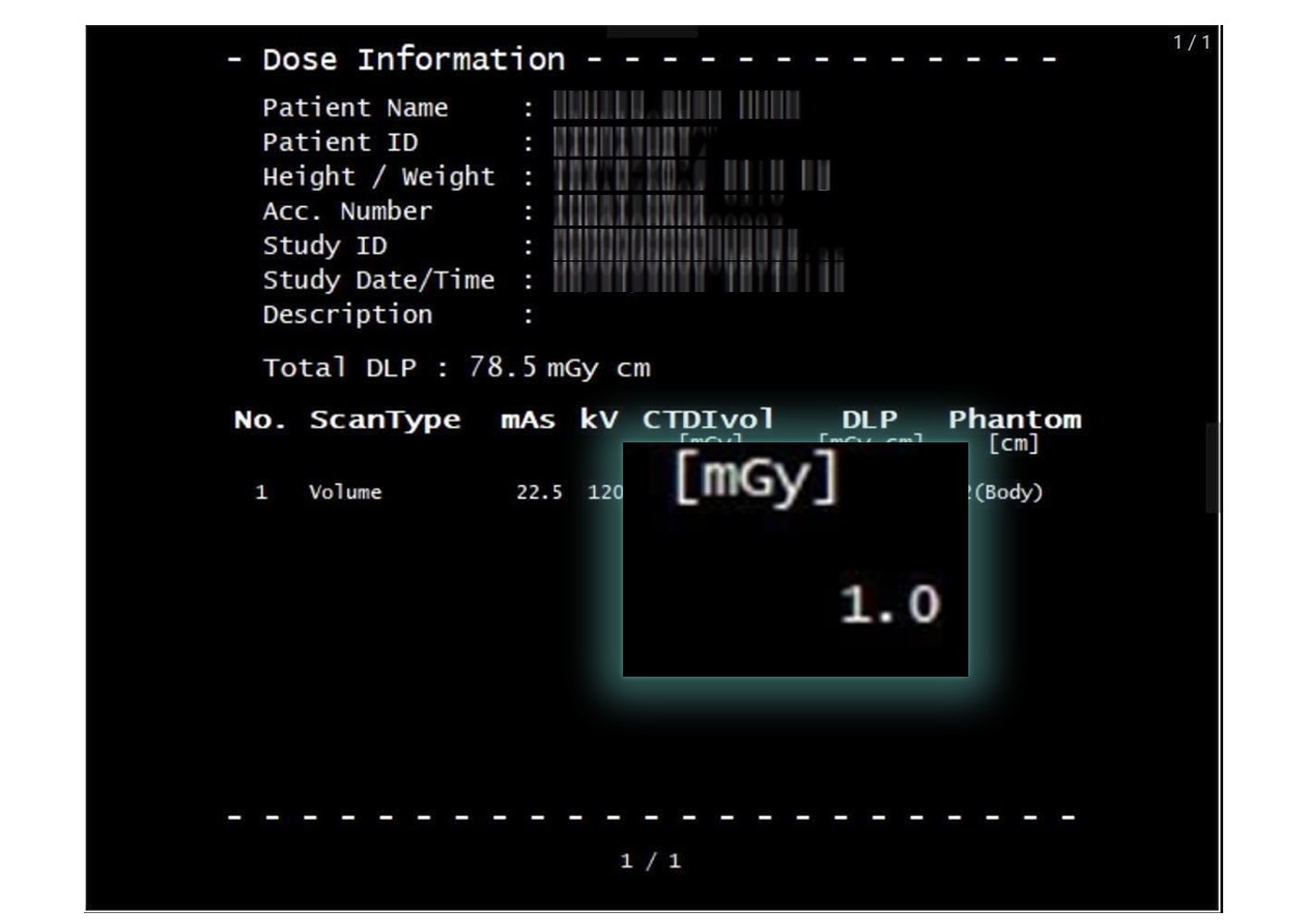 Một ca thực tế chụp CT chỉ sử dụng 1 mGy, giảm 92% liều tia X so với thông thường (10 - 15mGy).