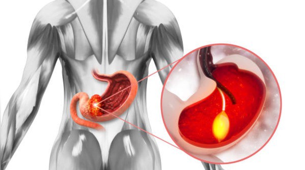 Ung thư tuyến tụy là sát thủ thầm lặng, làm thế nào để tránh? - 1