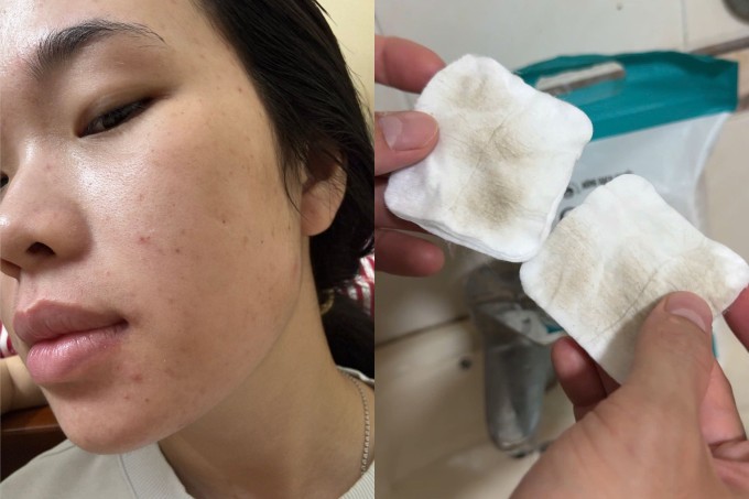 Những ngày ô nhiễm không khí, bông tẩy trang Linh dùng đen kịt, da mặt nổi nhiều mụn. Ảnh: NVCC