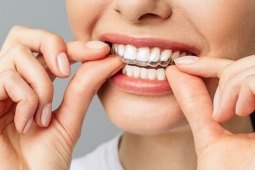 Phương pháp niềng răng tháo lắp là gì? Có bao nhiêu loại?