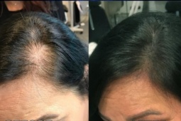 Điêu khắc đường chân tóc - 'cứu tinh' cho tóc thưa mỏng