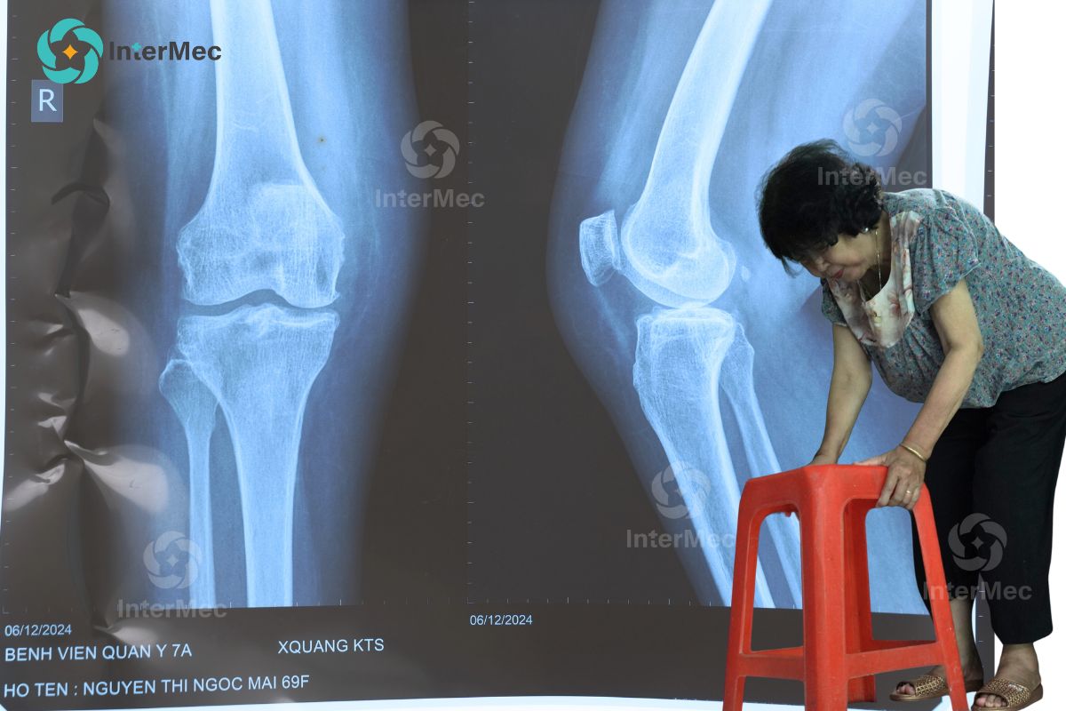 Thoái hóa khớp: Lối thoát nào cho người già sợ phẫu thuật? góc nhìn từ chuyên gia InterMec - 6