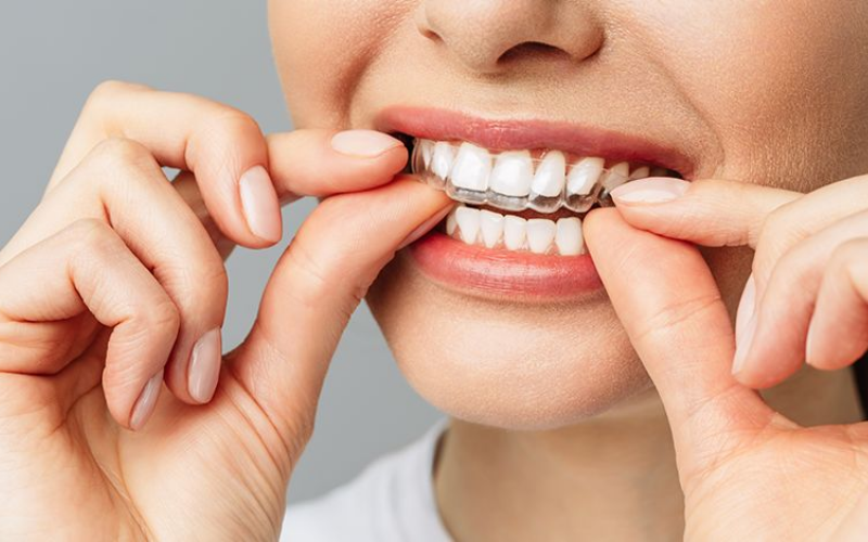 Niềng răng bằng khay niềng trong suốt Invisalign