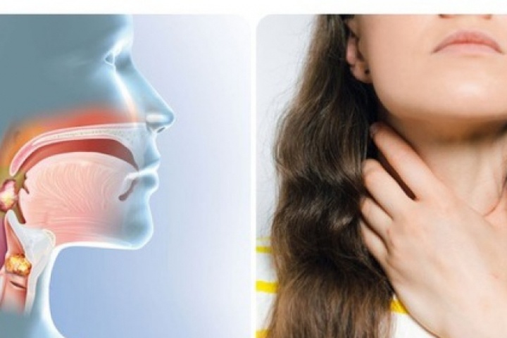 Đau họng có phải dấu hiệu của ung thư vòm họng?